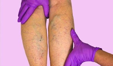 Cosa può e non può essere fatto con le vene varicose