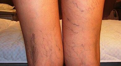 Come trattare l'espansione varicone delle donne nelle donne