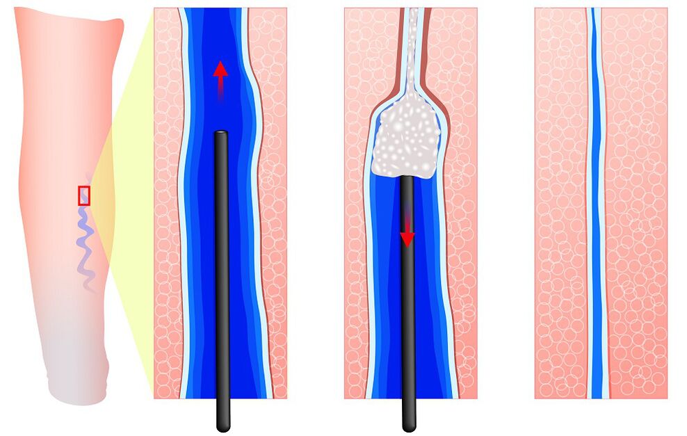 Meccanismo della scleroterapia